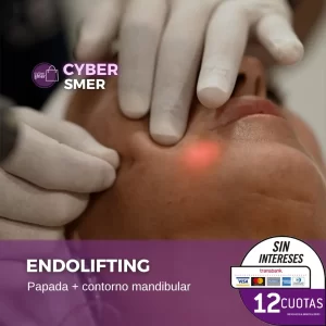 Endolifting Papada + Contorno Mandibular