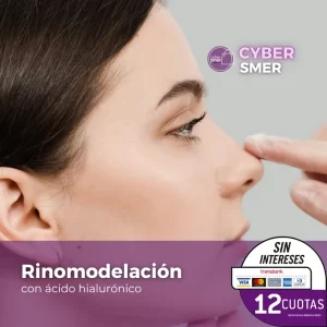 Rinomodelación  con ácido hialurónico