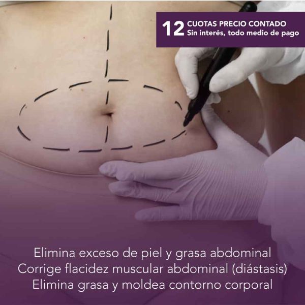 Abdominoplastía + Lipoaspiración de Abdomen y Flancos + 5 sesiones drenaje linfático