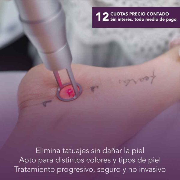 Borrado de Tatuajes – Láser ND-YAG