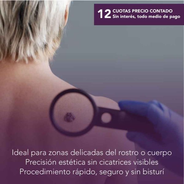 Extracción de Lunares – Láser CO2
